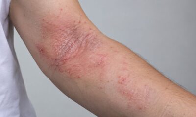 atopic dermatitis