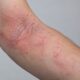 atopic dermatitis